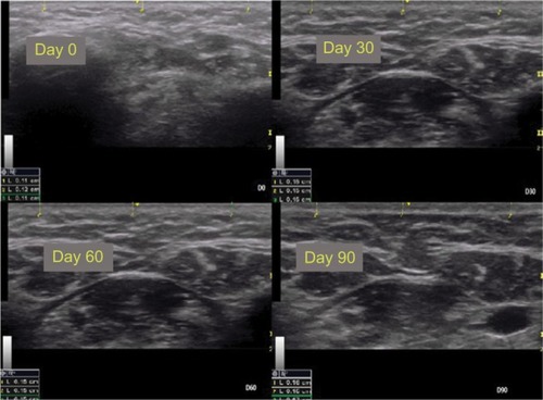 Figure 5 Ultrasound images of the submental region (patient 1).