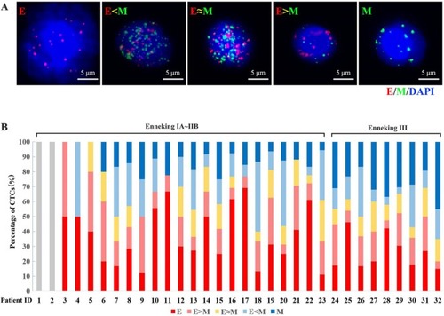 Figure 1 (A) Five subtypes of CTCs (E-CTCs, E>M-CTCs, E≈M-CTCs, E<M-CTCs, and M-CTCs) were detected from the peripheral blood sample of osteosarcoma patients based on the expression of EMT-related markers and RNA-ISH. (B) The pretreatment CTC detection in 32 osteosarcoma patients and the percentage distribution of the five subtypes in each patient.Abbreviations: CTC, circulating tumor cell; E, epithelial; M, mesenchymal; EMT, epithelial-to-mesenchymal transition; RNA-ISH, RNA in situ hybridization.