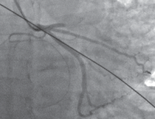 Figure 1. Coronary angiography showing acute occlusion of the proximal LAD.