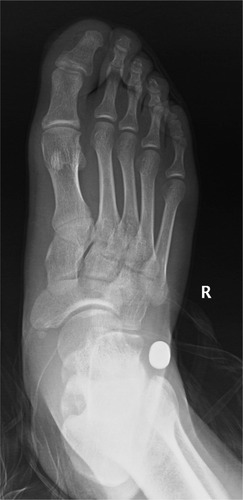 Figure 3 Anteroposterior X-ray showing fixation failure of the subtalar implant at 7 months postoperatively.