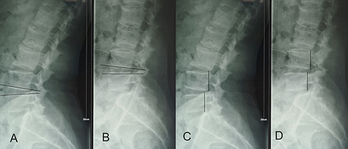 Figure 4 The changes in angulation (A and B) and translation distance (C and D) on the lateral flexion and extension were used to reflect the spine’s stability.