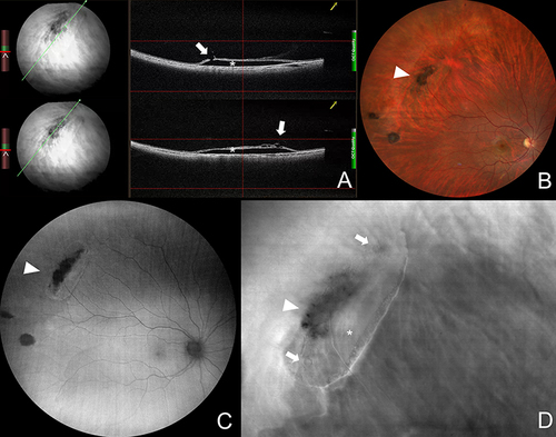 Figure 7 Multimodal imaging in lattice degeneration. (A) Snapshots of live cross-sectional optical coherence tomography showing holes (arrows) and retinal detachment (asterisk). (B) Wide-field color fundus photography shows moderately pigmented lattice degeneration lesion (arrowhead). (D) Wide-field fundus autofluorescence showing hypointense signal within the lesion (arrowhead). (C) Retro-mode scanning laser ophthalmoscopy shows retinal holes (arrows), retinal detachment (asterisk), and hyporeflective region within the central part of the lesion (arrowhead).