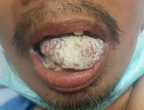 Figure 1 Whole of the intraoral mucosa and tongue surface covered by white plaque.
