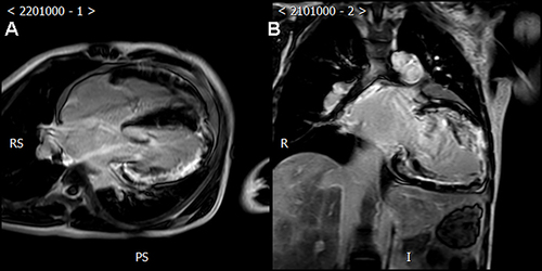 Figure 5 (A and B) 24-year-old male patient’s two-chamber and four-chamber PSIR image shows LGE diffusely distributed at the sub-epicardium.