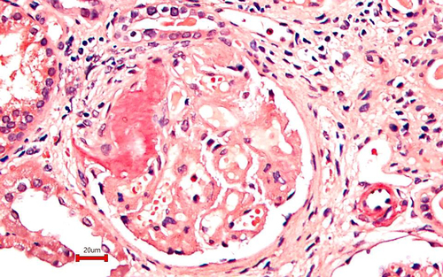 Figure 2. Congo red staining of glomerulus showing congophilic amyloid in hilar vessels and mesangium (Congo redx400red x400).