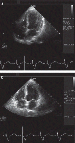 Figure 2. Acute left ventricular ballooning at two-dimensional echocardiography (a) systole, (b) diastole.