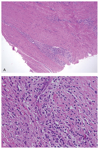 Figure 2. Histological slides retrieved from a patient without periarticular cystic cavities (ballooning osteolysis). Perivascular infiltration by lymphocytes can be seen.