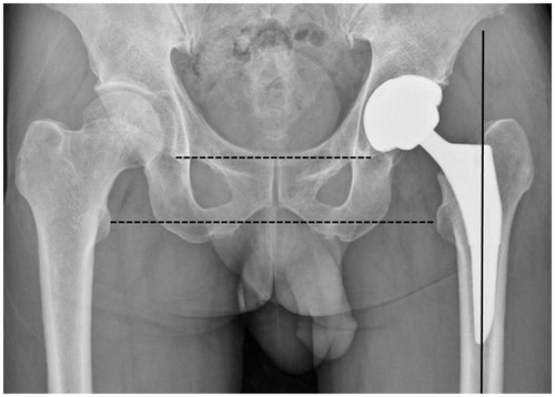 Figure 3. Anteroposterior radiograph of both hips after robotic milling THA shows that stem is fixed in a satisfactory position with no leg length discrepancy.