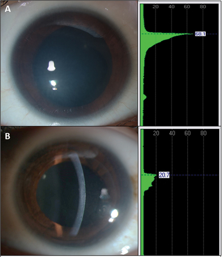 Figure 3. Average central densitometry values. (a) Right eye of a patient with CHED – value of 68.1. (b) Left eye of the same patient post DSAEK showing reading of 20.7. Thus, showing the amount of clearing of the opacity post DSAEK.
