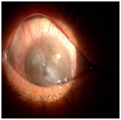 Figure 1 Corneal ulcer before the penetrating keratoplasty.