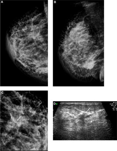 Figure 5 A 48-year-old female patient presented with hard right breast mass of 2 months duration. (A–C) CC, ML, and magnified mammogram views of the right breast revealed an irregular spiculated dense mass at the lower outer quadrant of the right breast. A magnified view shows clusters of pleomorphic microcalcifications within the lesion (arrows). Four foci of calcifications are seen away from the lesion. (D) Ultrasound revealed an ill-defined mass of heterogeneous echopattern at 8 o’clock of left breast.