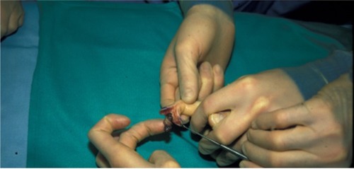 Figure 2 Intraoperative view of a cystic brown tumor with a soft consistency.