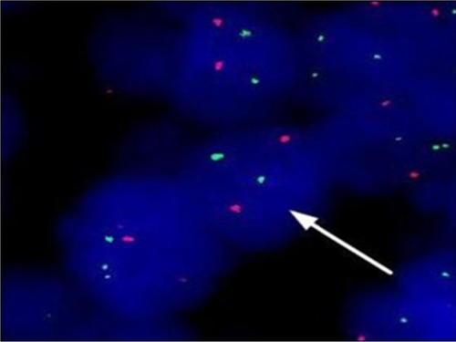 Figure 2 The result of BCL/ABL1 fusion gene in swollen lymph node biopsy by FISH (arrow displays that lymphoma cells without BCR/ABL1 fusion genes).