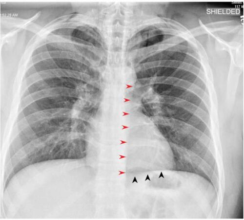 Figure 1 Chest X-ray PA view of the patient on the day of admission shows a “continuous diaphragm sign” characterised by a mediastinal gas outlining the superior surface of the diaphragm and separating it from the heart (black arrowheads) and a “Naclerio’s V sign” in which mediastinal gas outlines the lateral margin of the descending aorta and extends laterally over the left hemidiaphragm (red arrowheads).