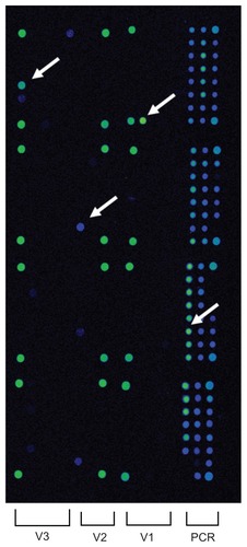 Figure 3 Results of the hybridization assay for polymerase chain reaction (PCR) amplifications from vitreous sample of case 2. PCR products are spotted as a reference in the right side. Green or blue (arrow) circles in V1, V2, and V3 represent strong hybridization. Bacterial identification is determined by the combination of strong hybridization in V1, V2, and V3. This case shows a pattern of Streptococcus agaractiae.
