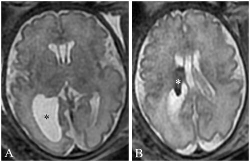 Figure 1. T2 axial MR images at 32 gestational weeks demonstrating unilateral ventriculomegaly (A, black asterisk) with hyposignal appearance (B, white asterisk) suggestive of bleeding.