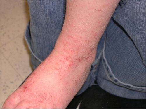 Figure 2 Flexoral eczema on the ankle of a child.