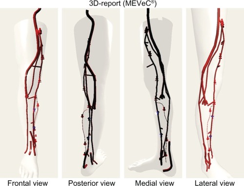 Figure 2 Frontal, posterior, medial, and lateral view of the three-dimensional (3D) report (MEVeC®; Health Department, Tecnopolis, Science and Technology Park, University of Bari, Bari, Italy). The arrows directed downward express the presence of a venous reflux. The upward arrows indicate the continence of the veins. The interactions between deep and superficial veins are clearly expressed.