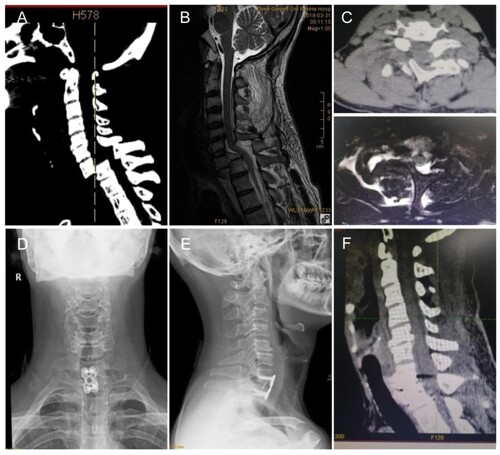Figure 3 Imaging examinations of case 3. (A–B) Sagittal CT and MRI of the cervical spine showed grade IV spondylolisthesis and pathological enlargement of the spinal canal at C7. (C) Axial image of C7 displayed bilateral fractures at the junction of the bilateral lamina and pedicle. (D–F) Postoperative X-ray films and CT showed that the cervical spine was well realigned and width of the spinal canal had been restored