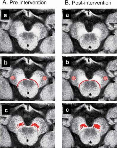 Figure 2. Analysis of neuromelanin magnetic resonance imaging (NM-MRI).