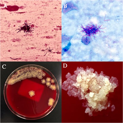 Figure 1 (A) The Gram stain of the specimen was a cluster of blue-purple, indicating that the organism was Gram-positive bacilli. (B) Weak acid-fast staining was red, indicating that the bacteria was positive for weak acid-fast staining. (C) Dry, rough, and branched bacterial colonies with a little yellowish pigment appeared on the blood agar plate. (D)Under the microscope, the colony morphology was clear.