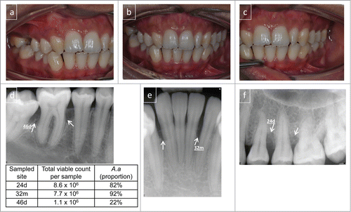 Figure 1. Clinical presentation of localized aggressive periodontitis. A 16-year old female presenting with radiographic alveolar bone loss associated with bone defects (marked with arrows) and probing attachment loss at 2 permanent first molars, left upper premolars and lower incisors. Clinical photographs buccal view (A–C). Radiographs (D–F). The clinical presentation shows sparse plaque accumulation and localized gingival inflammation with 4–8 mm periodontal crevices with bleeding on probing in the affected regions. The results from the microbial sampling are presented in the inserted table and the sampled sites are indicated. Microbiological analysis, by cultivation technique, confirmed the presence of high levels of A. actinomycetemcomitans in the 3 lesions sampled. Diagnosis: localized aggressive periodontitis (LAgP).