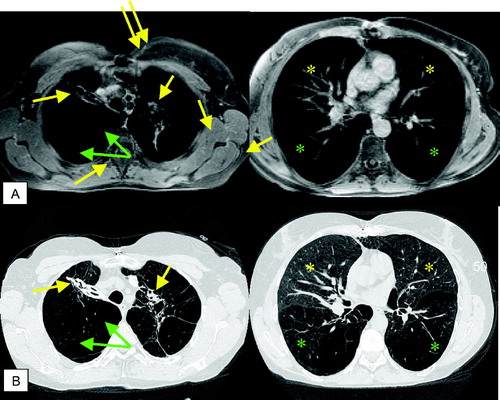 Figure 4 T1 weighted GRE (VIBE) post contrast (A) and corresponding HRCT (B): scar tissue (yellow arrows) and emphysematous bullae (green arrows) in the apical regions; centrilobular changes in the middle lobe and lingula (yellow asterisks), severe panlobular emphysema (green asterisks) in the lower lobes. Note the nice delineation between the centrilobular and panlobular changes by signal intensity (A, right image) on MRI.