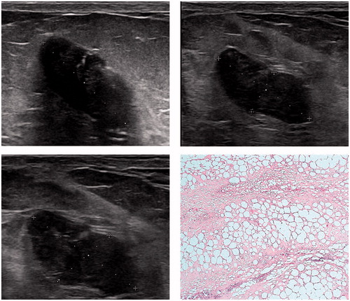 Figure 5. Ultrasound images (pre-treatment – 22*12*12 mm, 2 week follow-up – 19*8*10 mm and 3 months follow-up – 19*8*10 mm) showing no change in volume and histopathology outcome of a patient who underwent surgical excision 3 months after HIFU treatment, showing fat necrosis and fibrosis.