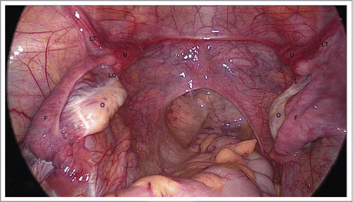 FIGURE 2. Uterovaginal Aplasia Corresponds to Early Stage of Embryogenesis. O – ovary, F – Fallopian tube, LO – ligamentum ovaricum proprium, LT – ligamentum teres uteri U – uterine rudiment, Laparoscopically there are two uterine rudiments (U) detected in the crossing area between the Fallopian tubes (F) with ligamentum teres uteri (LT) and ligamentum ovaricum proprium (LO).