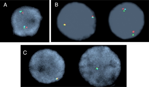 Figure 1 Interphase nuclei representing TET2 FISH signal patterns. A) Normal nuclei with two triple color fusion signals. B) Deletion of the 175 kb RP11-16G16 BAC probe (aqua). C) Deletion of all three bacterial artificial chromosome probes; note only one triple color fusion signal.