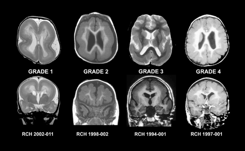 Figure 5. Imaging features of classical lissencephaly showing the four severity grades. All images are T1 - or T2 -weighted MRI scans. The top row shows axial scans and the bottom row coronal scans. Grade 1 is near complete agyria, grade 2 is posterior agyria and rudimentary shallow gyri anteriorly, grade 3 is posterior agyria and anterior pachygyria, and grade 4 is generalized pachygyria. MRI, magnetic resonance imaging