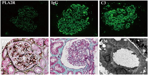 Figure 1. Biopsy finding of patients with IMN who were glomerular PLA2R staining-positive (GAg+). immunofluorescence includes staining for PLA2R, IgG and C3.