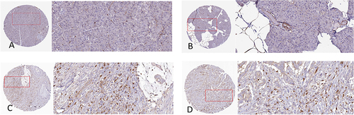 Figure 6 (A and B) indicates the expression of DPYD in normal pancreatic tissues; (C and D) indicates the expression of DPYD in PC tissues; DPYD in (C and D) was highly expressed, while DPYD in (A and B) was almost not expressed.