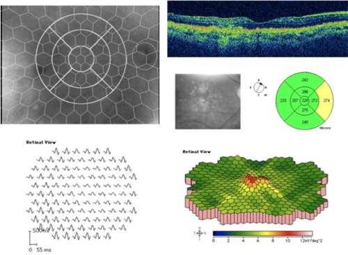 Figure 1 OCT and mfERG (103 hexagons) in an eye with drusen maculopathy (picture from IR camera).