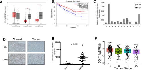 Figure 1 SOX17 expression is decreased in primary RCC tissues compared with that in adjacent non-malignant kidney tissues. (A) Expression of SOX17 in RCC tissues and normal tissues. *p<0.01. (http://gepia.cancer-pku.cn); (B) Kaplan-Meier overall survival (OS) curve for patients with ccRCC between the two clusters. (C) Real-time PCR revealed SOX17 mRNA expression levels in 12 paired RCC tissues, N (black columns): adjacent non-malignant renal tissues, T (empty columns): primary RCC tissues, p<0.05. (D) Immunohistochemistry staining showed SOX17 expression in 20 paired RCC samples at 40× and 200× magnification. (E) Image Pro Plus software was used to analyze the SOX17 quantitative protein expression; p<0.001. (F) SOX17 mRNA expression at different stages of ccRCC (http://tumorsurvival.org/).