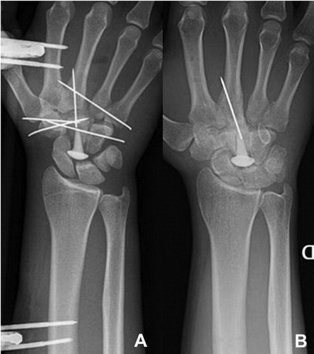 Figure 4. (A) Post-operative x-ray case 2. (B) X-ray at 29 months’ follow-up, after removal of the external fixation and K-wires.