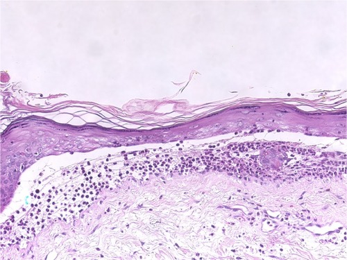 Figure 5 Bullous lupus erythematosus.