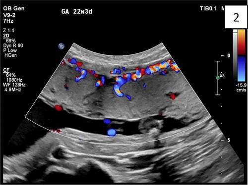 Figure 2. Normal appearance of the anterior placenta: homogeneous, hypoechoic, and subplacental zone (‘clear zone’ with subchorionic, continuously normal blood flow).