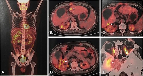 Figure 3. Post-operative PET-CT scan. PET-CT showed high radioactive uptake in the right and anterior abdominal wall (A), liver lobe (B, C), colonic wall (D), and active lesions in the sphenoid sinus (E).