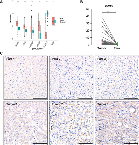 Figure 9 SCN4A is highly expressed in HCC tissues (A) MPRGs expressions in HCC of TCGA-HCC dataset. (B) qPCR result of SCN4A expressions in HCC of patients. (C) Representative IHC staining of SCN4A expressions in HCC of patients. Bars=100 μm. * P < 0.05, *** P < 0.001, **** P < 0.0001.