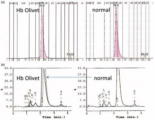 Figure 2. (a) Capillary electrophoresis (Sebia) pattern of the Hb Olivet carrier (left) and a normal control (right), no abnormal pattern was observed. (b) High performance liquid chromatography (VARIANT II™; Bio-Rad Laboratories) result of the Hb Olivet carrier showed an atypical pattern with the abnormal Hb fraction partially overlapping the Hb A fraction. The normal pattern is indicated as dashed lines overlaying the Hb Olivet pattern on the left.
