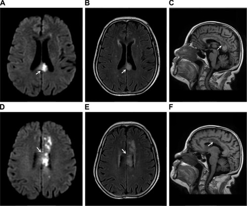 Figure 2 Case 2 magnetic resonance imaging and MRA of brain.