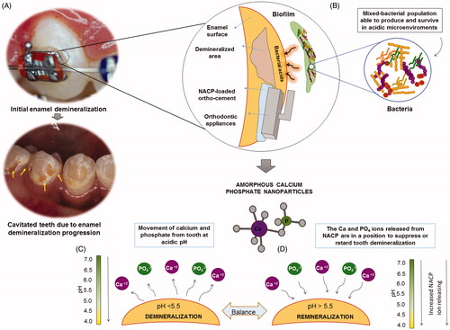 Figure 1. Diagrams illustrating the pH-responsive NACP approach to dealing with the dissolution–diffusion process of dental caries: (A) The demineralization of enamel adjacent to orthodontics brackets are characterized by mineral loss with a white appearance. The initial demineralization is the precursor of frank enamel caries. If the enamel demineralization is not controlled, it will progress to irreversible stage of cavitated lesions (the arrows point out the cavited areas after the orthodontic treatment has finalized and the brackets removed); (B) Bacterial attachment to enamel and orthodontic appliances surfaces; acid is produced by the cariogenic biofilm; the subsurface demineralization of tooth requires diffusion of acid ions into, and solubilized mineral ions out of the lesion to form the surface-softened demineralization, that progress to a subsurface lesion over time with the “body of the lesion” consisting of partially demineralized enamel; (C) The bacterial acid reduces the pH, calcium, and phosphate ions are removed from tooth; (D) NACP in an ortho-cement releases calcium (Ca) and phosphate (P) ions. The ions will suppress or retard tooth demineralization as well as facilitate tooth remineralization.