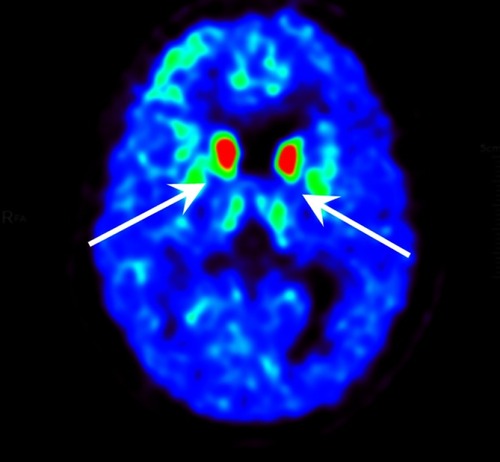 Figure 4 PET-CT image of VMAT2 distribution in a Hoehn–Yahr stage 3 patient without freezing of gait. Two white arrows show the dopamine decline of bilateral putamen.