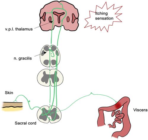 Figure 5 Interrelation between visceral and cutaneous nociceptive neurons.
