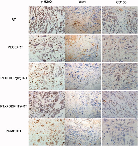 Figure 3. Immunohistochemical analysis of γ-H2AX, CD133, and CD31 in a mouse xenograft model. PTX: paclitaxel; DDP: cisplatin; PDMP: mixing mPEG-PCL/PTX micelles with DDP-loaded PECE hydrogels; IP: intraperitoneal injection; IT: intratumoral injection.