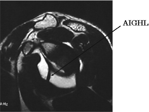 Figure 3. MRA, oblique sagittal section (with visualization of the AIGHL).