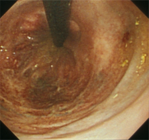 Figure 2 After EIS colonoscopy revealed shrinkage of the rectal varices.