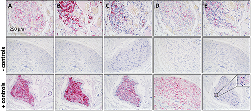 Figure 4. Immunostained sections from a CB specimen subjected to xylene based tissue clearing. Pink staining indicates immunoreactivity to primary antibodies. Nuclei are stained purple by hematoxylin counterstain. Human vagus nerve sections were used for negative and positive controls. A) Staining of protein gene product 9.5, a general neural marker. B) Staining of S100, present in type II/satellite or sustentacular cells. C) Staining of low molecular weight neurofilament (70 kDa) present in all nerve fibers. D) Staining of beta-III tubulin IgG2A, a general neural marker. E) Staining of tyrosine hydroxylase, present in sympathetic nerves. Scale bar in panel A applies to all panels.