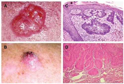 Figure 2 Illustrative pictures from a typical ulcerative of BCC and SCC from the face of an XP patient.